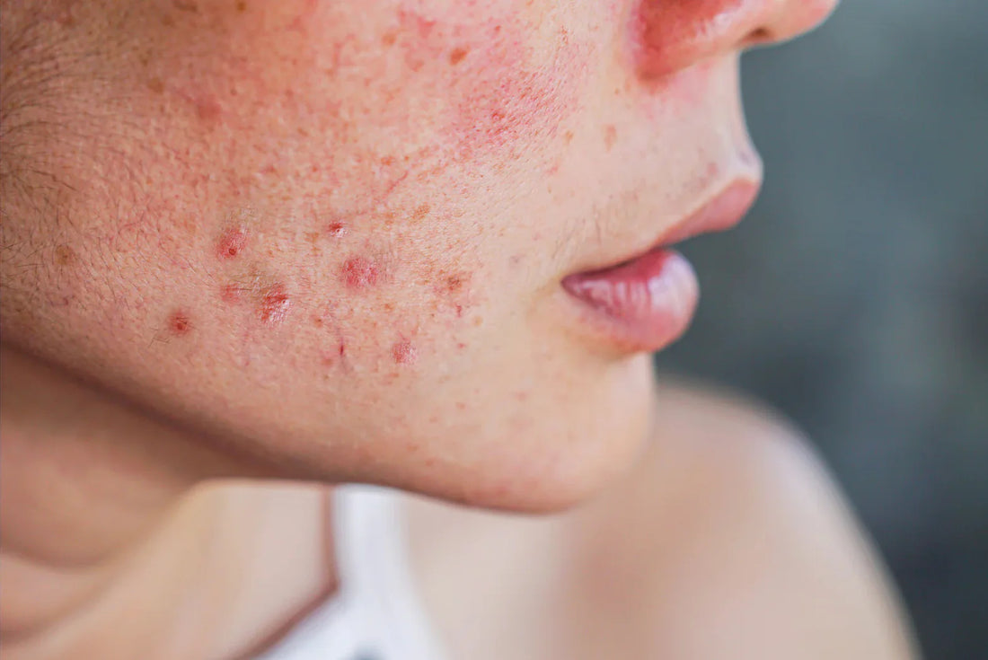 Comprehensive Guide to Acne & Effective Treatment Options: Expert Tips from Derma MD Clinics