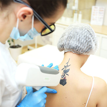 Tattoo Removal