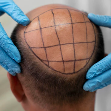 Hair Transplantation