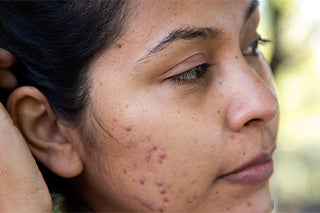 Acne & Acne Scars